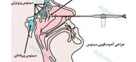 مراقبت جراحی اندوسکوپی بینی و سینوس