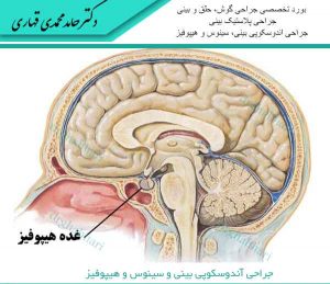 جراحی آندوسکوپی بینی و سینوس و هیپوفیز