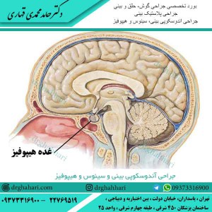 جراحی آندوسکوپی بینی و سینوس و هیپوفیز