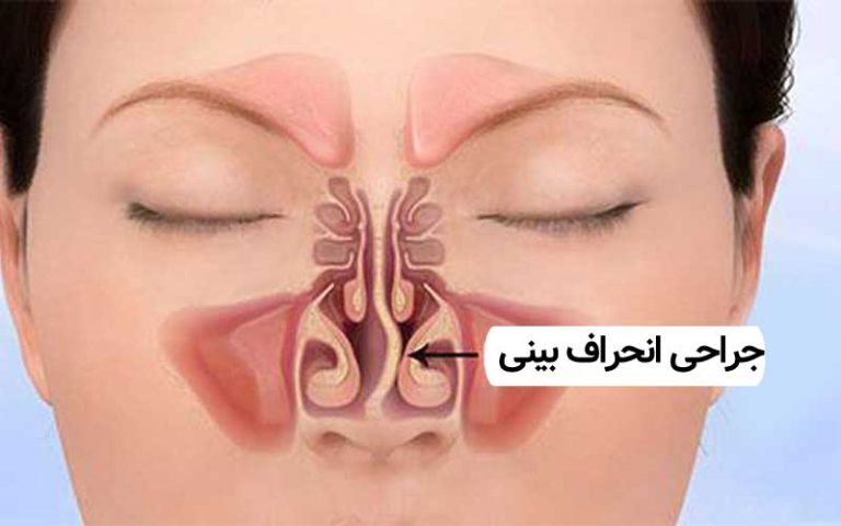 سپتوپلاستی بینی چیست؟