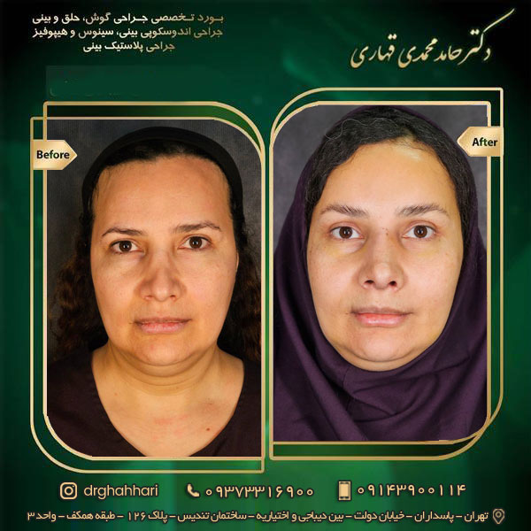 نمونه جراحی رینوپلاستی 02
