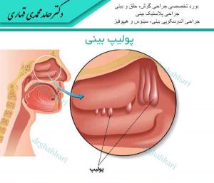 پولیپ بینی