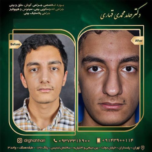 انحراف بینی 6 نمونه جراحی رینوپلاستی 01