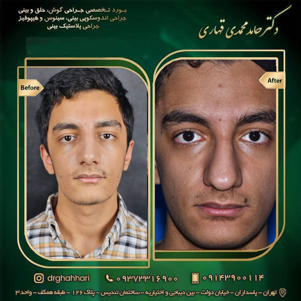 نمونه جراحی رینوپلاستی 01