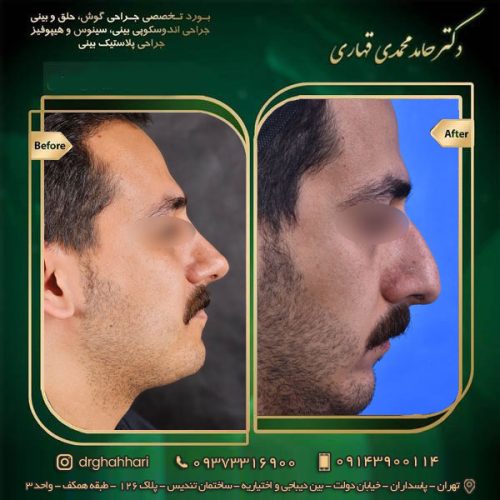 عمل بینی به روش بسته 8 نمونه جراحی رینوپلاستی 03