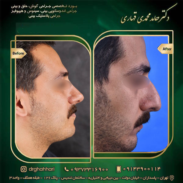 نمونه جراحی رینوپلاستی 03