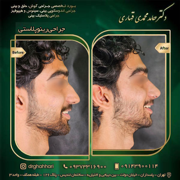 نمونه جراحی رینوپلاستی 04