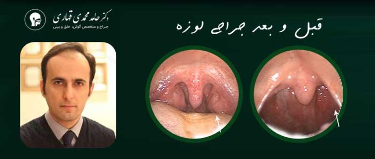 بهترین جراح لوزه در تهران