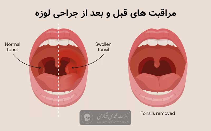 مراقبت های قبل و بعد از جراحی لوزه