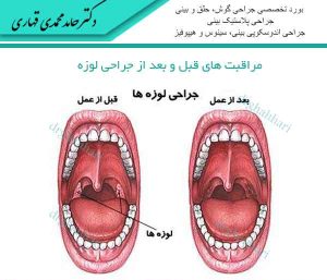 مراقبت های قبل و بعد از جراحی لوزه