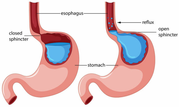 جراحی رفلاکس معده