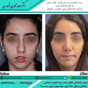 دستورات مراقبت جراحی زیبایی بینی