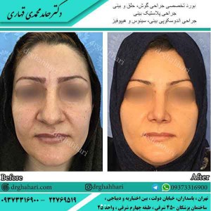 عمل جراحی بینی