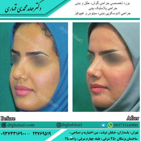 بهترین دکتر عمل بینی در تهران