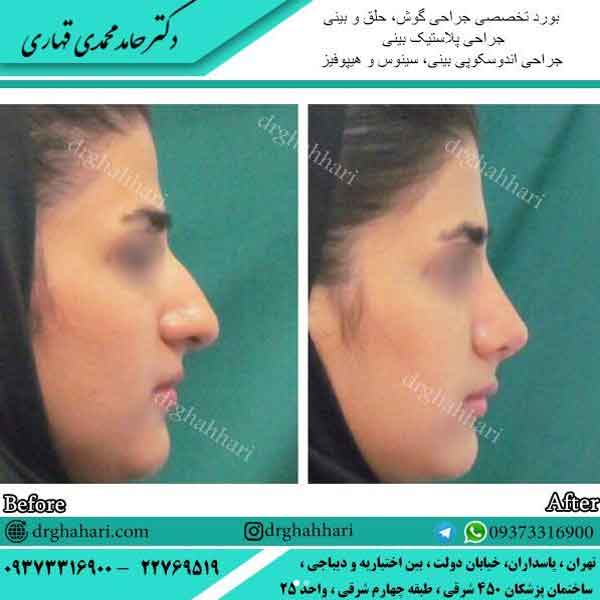 بهترین دکتر عمل بینی در تهران