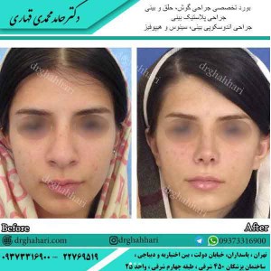  عمل بینی طبیعی