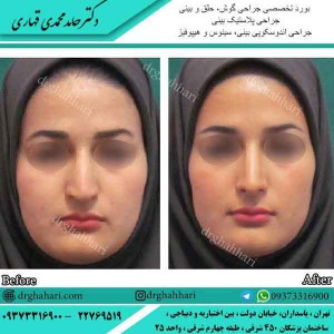 عمل زیبایی بینی در تهران