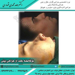 عمل زیبایی بینی