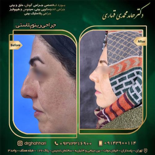 عمل بینی در افراد مسن