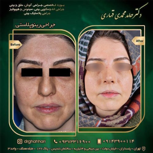 عمل بینی در افراد مسن
