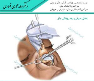 عمل بینی به روش باز