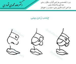 چسب زدن بینی