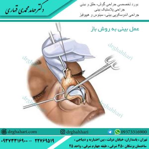 عمل بینی به روش باز 