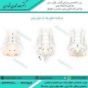مراقبت های بعد از عمل بینی