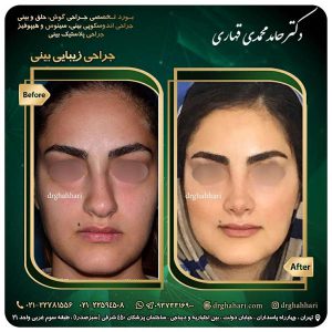 عمل بینی