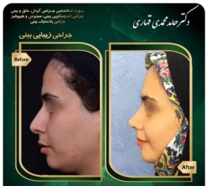 عمل بینی فانتزی در تهران - دکتر قهاری