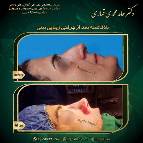 عمل بینی فانتزی در تهران - دکتر قهاری