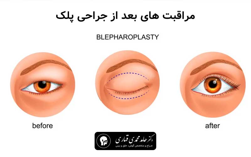 مراقبت های بعد از جراحی پلک