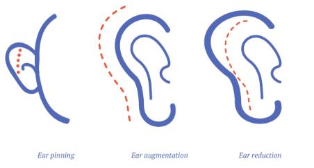 انواع جراحی زیبایی گوش یا اتوپلاستی