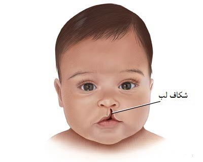 جراحی ترمیم لب شکری شکاف کام