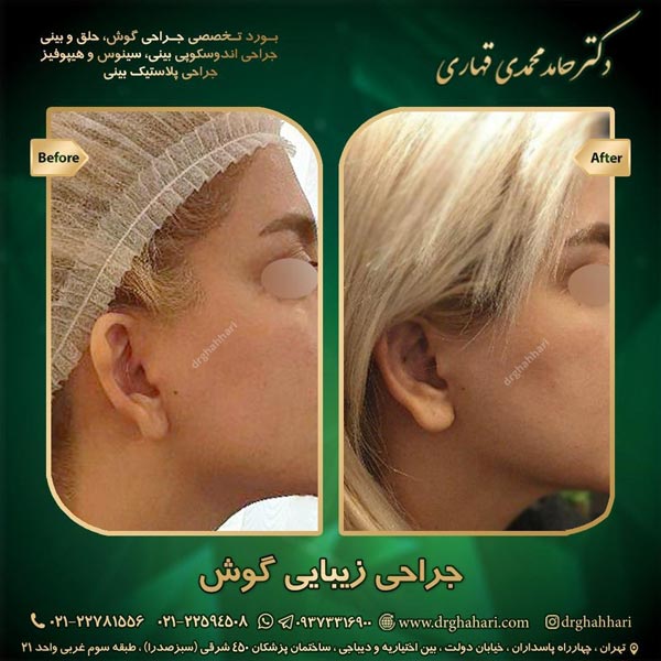 نمونه جراحی اتوپلاستی 12