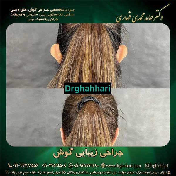 جراحی اتوپلاستی کودکان