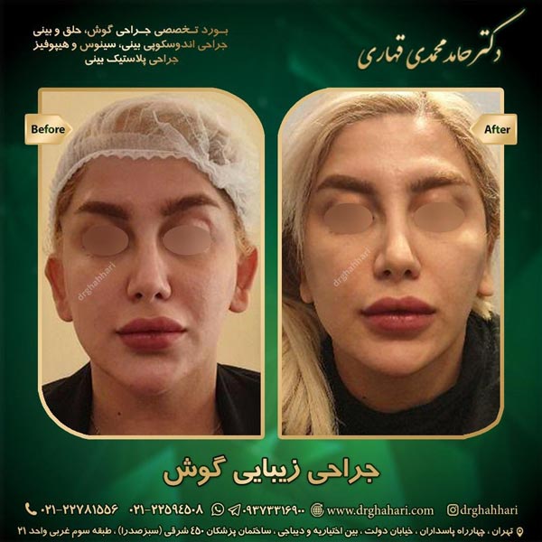 نمونه جراحی اتوپلاستی 11