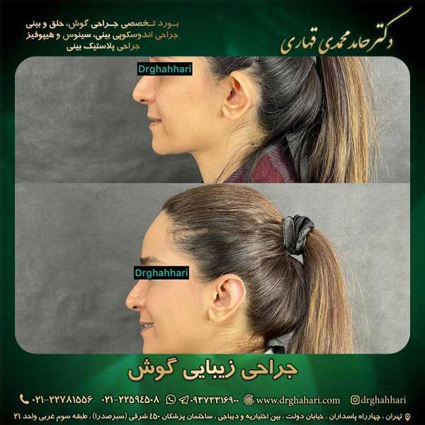 جراحی اتوپلاستی کودکان