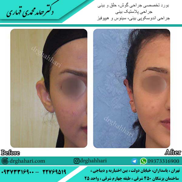 نمونه جراحی اتوپلاستی گوش 09