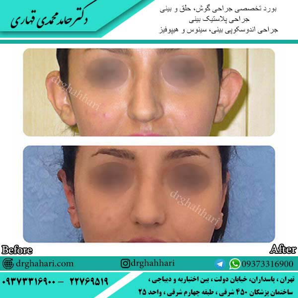 نمونه جراحی اتوپلاستی گوش 10