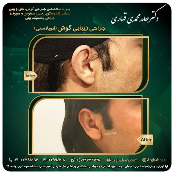 جراحی اتوپلاستی گوش تهران