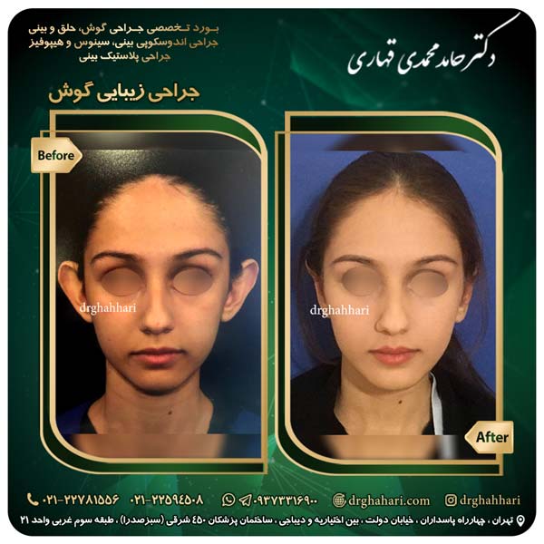 اصلاح فرم گوش با جراحی اتوپلاستی