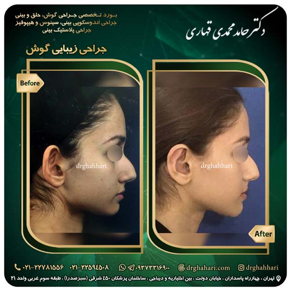 نتیجه عمل اتوپلاستی دو طرفه