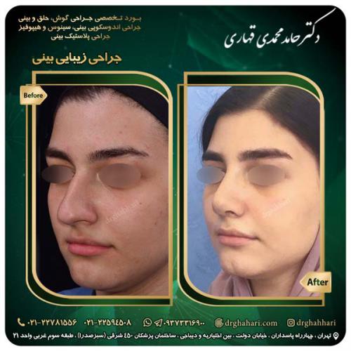 جراحی_بینی_513