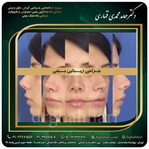 جراحی_بینی_528