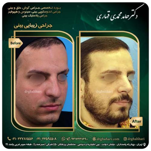 جراحی_بینی_546