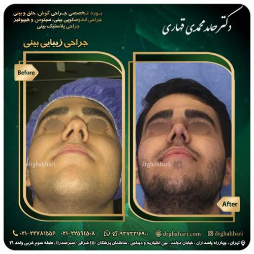 جراحی_بینی_551