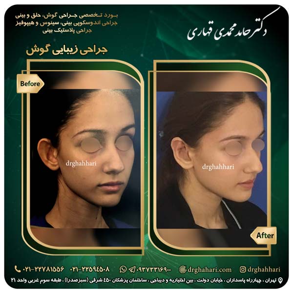 جراحی_گوش_10