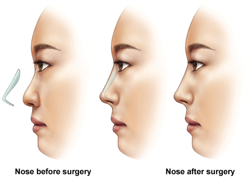 مراحل جراحی بینی گوشتی طبیعی