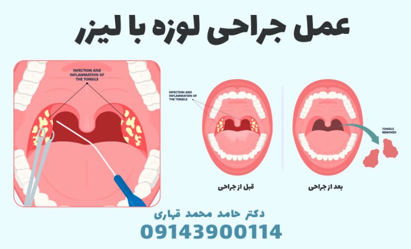 هزینه عمل لوزه در سال 1403